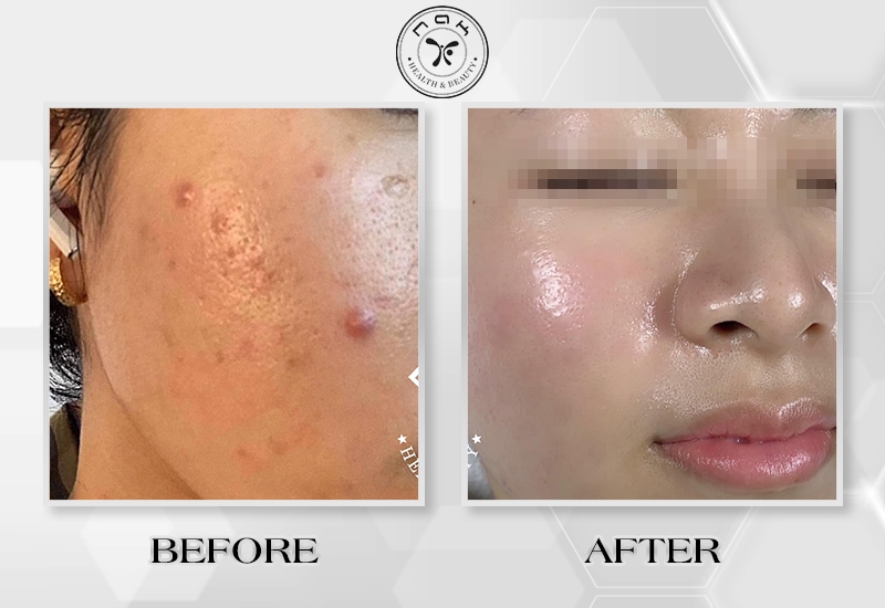 Before and after treatment