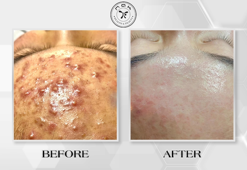 Before and after treatment