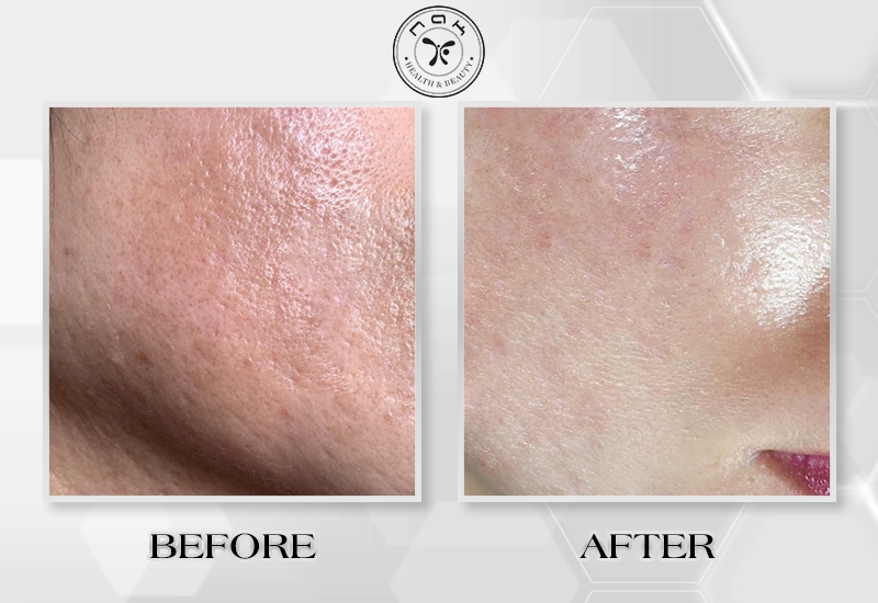 Before and after treatment