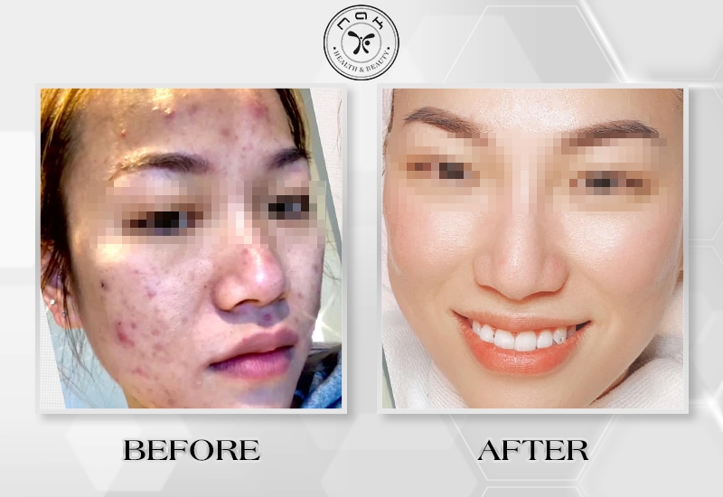 Before and after treatment